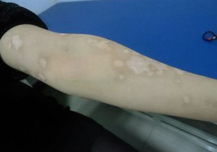 手臂上的白斑是什么因素引起的