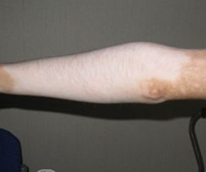 肢端型白癜风会给患者造成哪些伤害