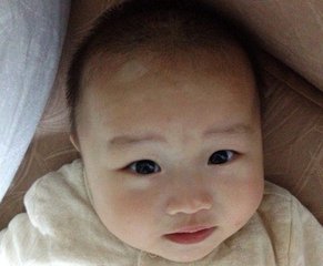 北京治疗白癜风最好医院：儿童白癜风该怎么护理